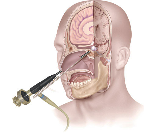 Skull base surgery